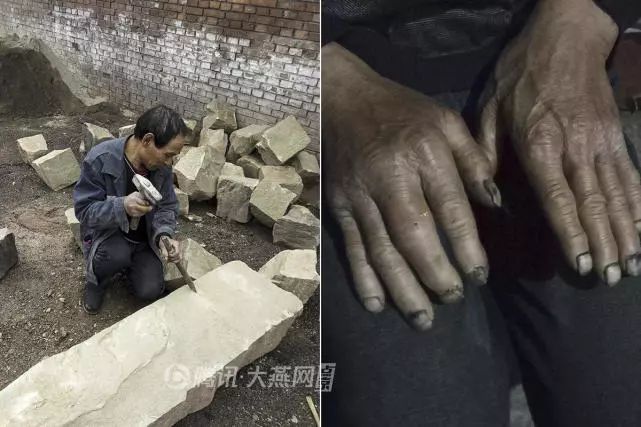 漂亮女孩患癫痫容貌大变 父亲下矿打工啃灰馒