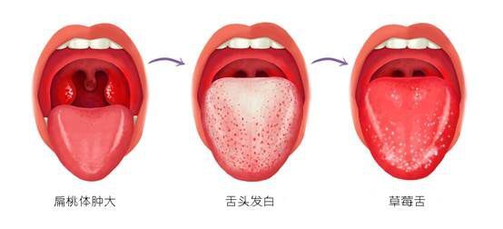 发烧、出疹、杨梅舌,这个病很常见,却折磨了我