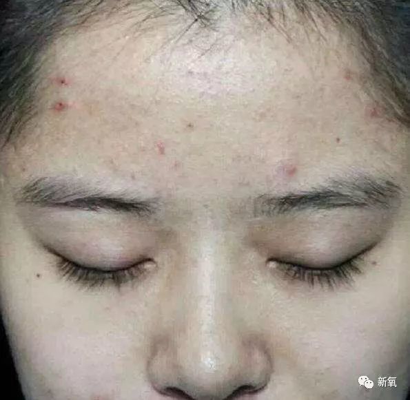 的问题可能更严重,不仅肤色暗黄,还可能有痘印,斑点,加上肤色不均匀