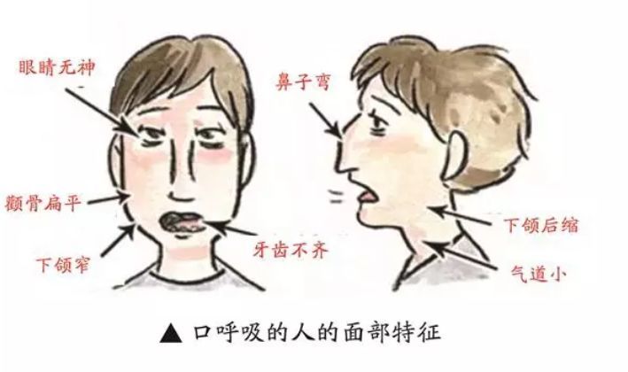 为什么牙医一眼就能看出孩子长期有口呼吸的习惯 腾讯网