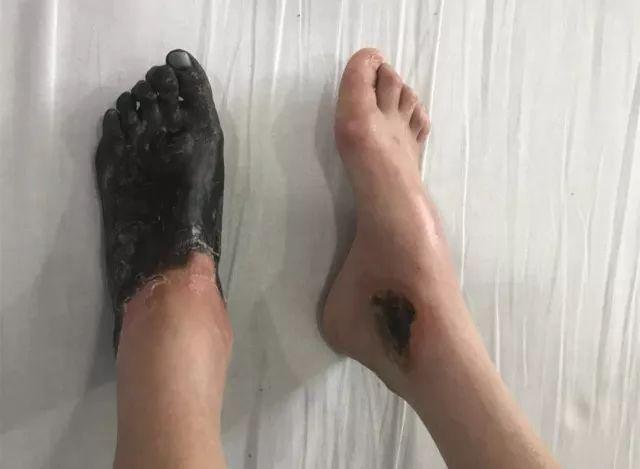 22岁女孩体重仅23公斤脚穿黑套袜因患脉管炎致左脚坏死