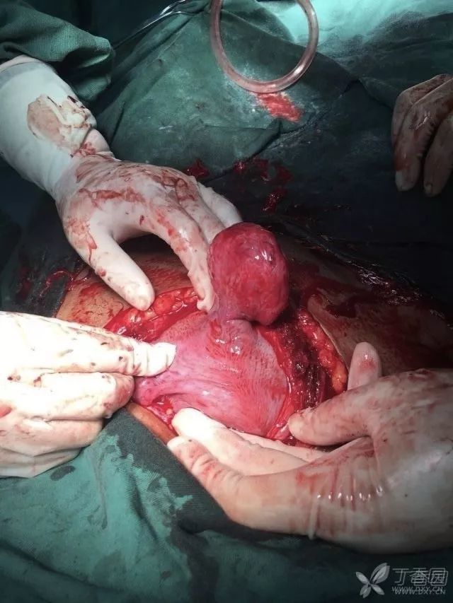 剖宫产刚打开,它"咻"地一下就立起来了!