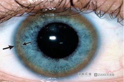 湖南一老人眼睛发绿像戴美瞳原是患肝豆状核变性