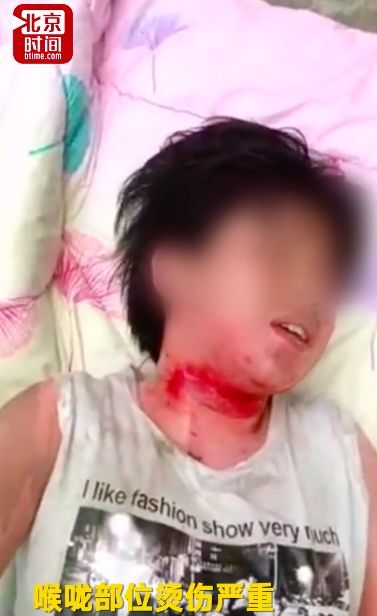 17岁少女惨遭开水泼脸 知情者:其母出轨 情人妻