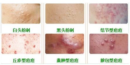 脸部痘痘上的小白点就是痤疮吗?揭秘面部