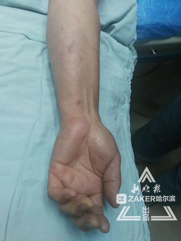 6厘米血栓卡在腋窝女子胳膊突然失去知觉险截肢