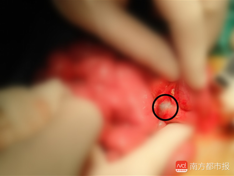 中山三岁男童反复腹痛呕吐!医生一查,体内竟有