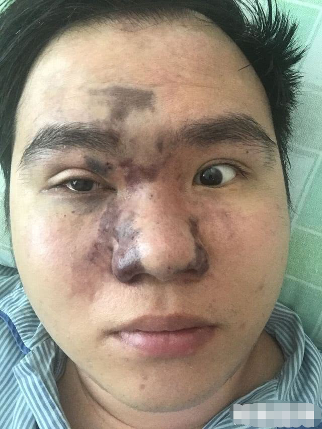 网红贪小便宜做免费隆鼻手术，结果导致毁容以及右眼失明