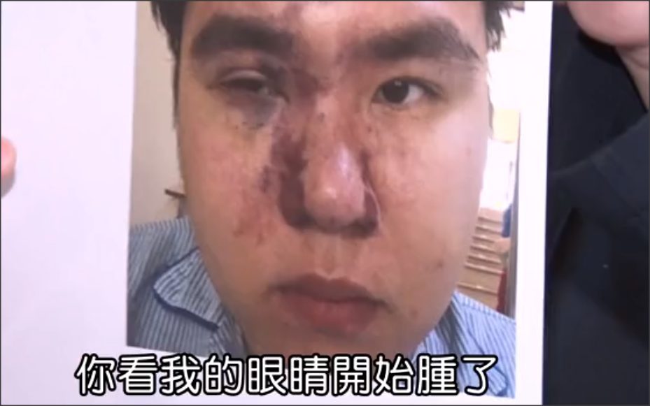 网红贪小便宜做免费隆鼻手术，结果导致毁容以及右眼失明