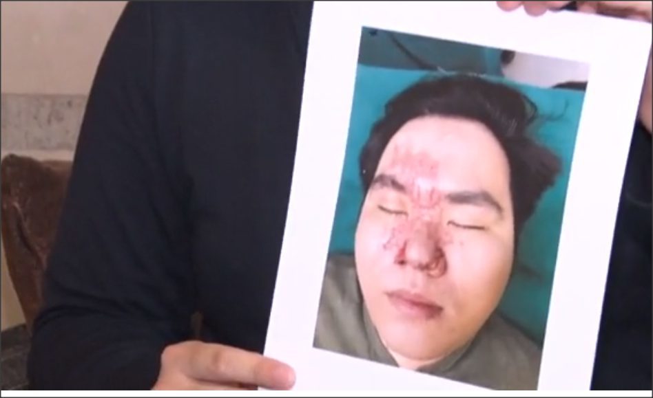 网红贪小便宜做免费隆鼻手术，结果导致毁容以及右眼失明