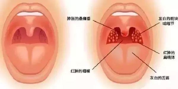 扁桃腺肥大原因 Halonbay