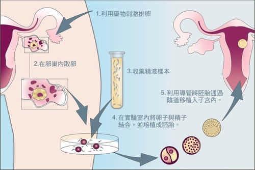 试管婴儿具体流程(试管婴儿的具体步骤百度百科)
