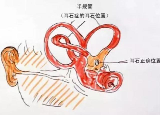 长沙男子早上起来就头晕,天旋地转,耳朵里这块