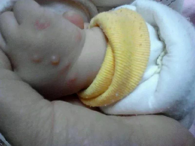 这12种宝宝常见皮肤病危害不比湿疹小,有的甚