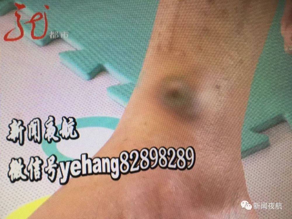 腿部做完手术,钢板竟然在外露着!医院:我们也没