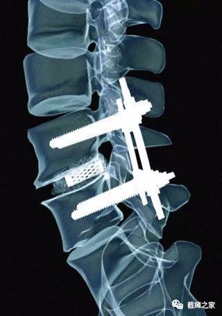 脊柱骨折內固定我取還是不取?