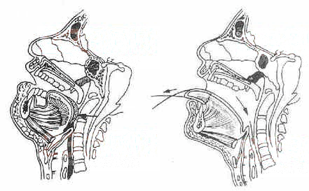 舌后坠示意图第一张图就是舌后坠时的情形,舌头向后移位阻塞了呼吸道.