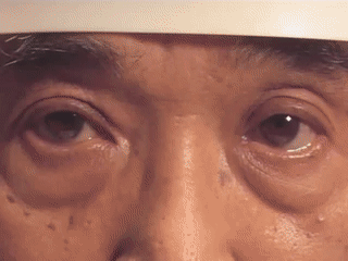 这8 种眼震,你都能分清吗(附动图及影像)
