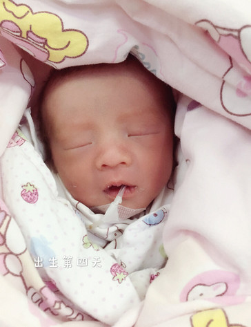 重度子痫生下34周早产儿,漫长21天就像场噩梦