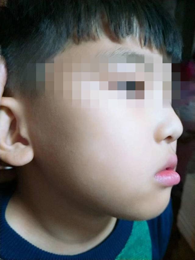 大连美林小学学生遭校长拳打家长为儿讨回公道