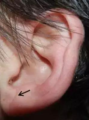 耳朵上这种"褶",表示心脏有问题?还真有可能…你的耳朵有吗?