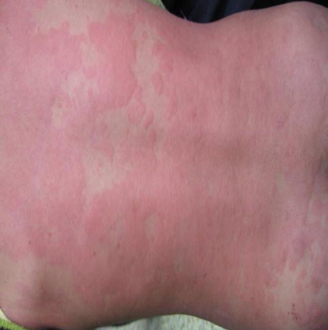 男子逛花店身上长红斑医生提醒办年货警惕过敏