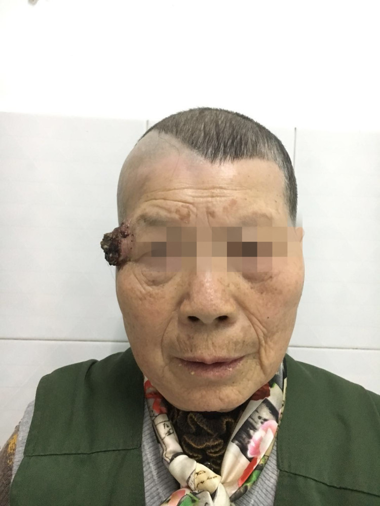 益阳75岁娭毑太阳穴长菜花忍痛割瘤保住面子