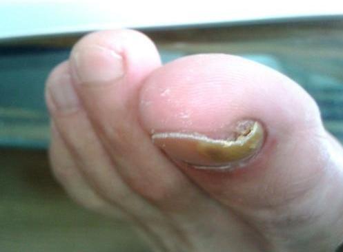 脚趾甲长到肉里面真的麻烦,医生教你正确处理