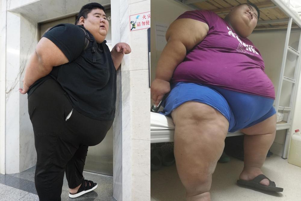 688斤宅男减重349斤皮肤松如沙皮狗