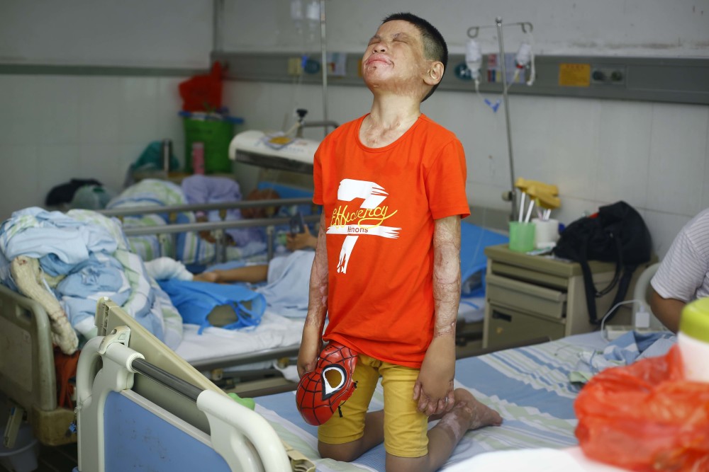 10岁男孩不幸烧伤被人喊"好丑" 哭诉:妈妈 不要抛弃我