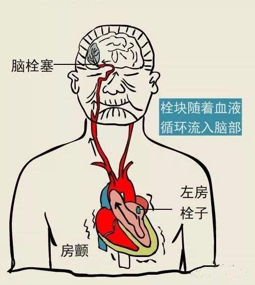 脑梗死位置图图片