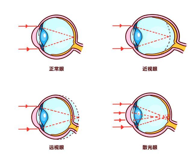 眼镜正常的轴位是多少度，眼镜正常的轴位是多少度的