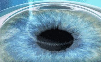 近视手术|近视手术安不安全？