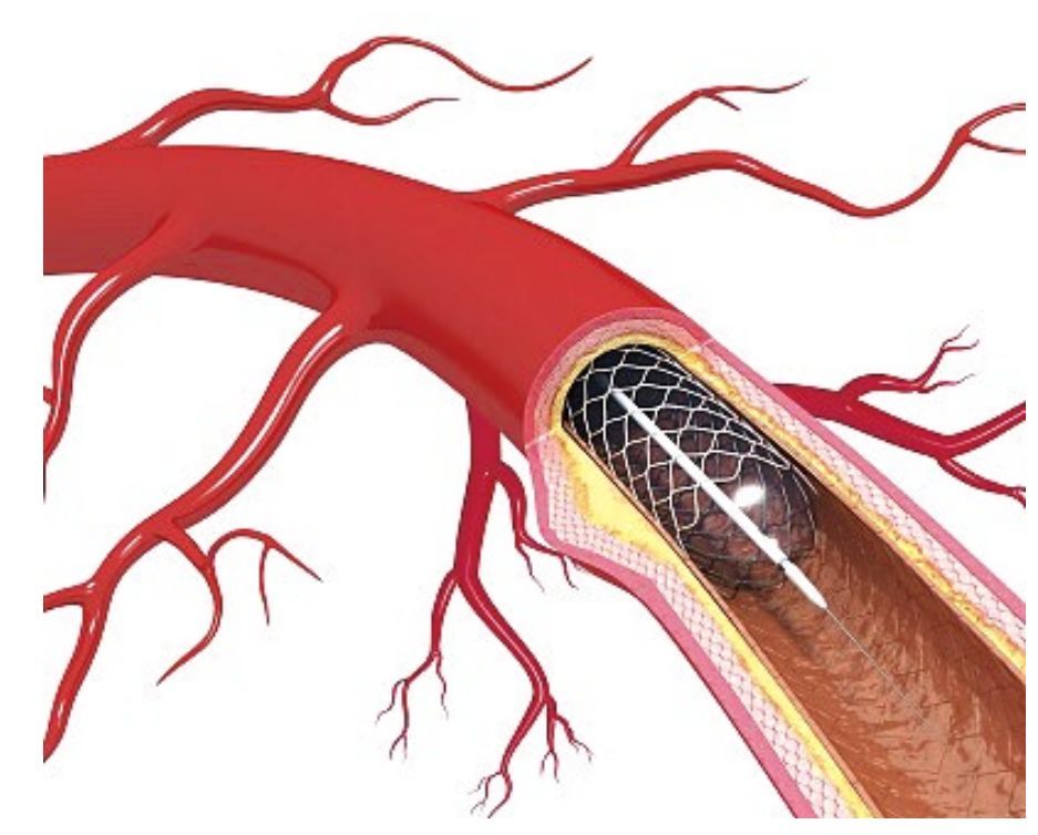 心臟支架術後不養護,小心血管再次堵塞!