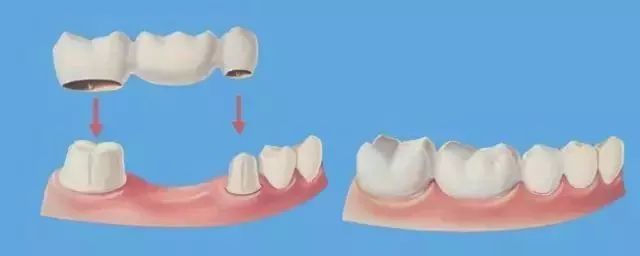 牙齒掉了為啥要及時補?