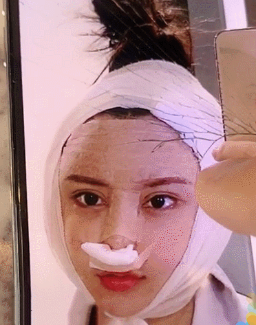 韩安冉自曝整容后,满脸绷带"吓哭小孩",网友:怪物史莱克?