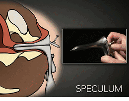 最让人害怕的妇科检查,为啥是鸭嘴钳?