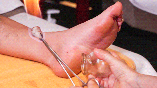 "热"知识:夏天拔罐,效果反而更好