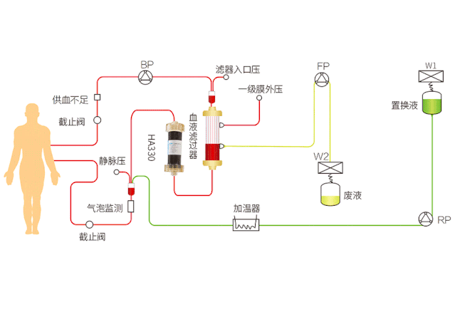 降低血液灌流器凝血,助力 hp 治疗全攻略