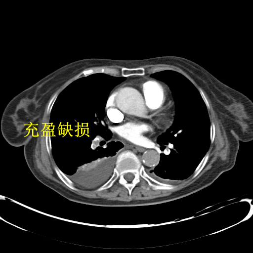 肺动脉 cta 不会看?这篇教你轻松诊断肺栓塞!