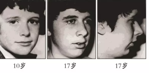 拉低儿童颜值的『腺样体面容』!睡觉打鼾,张口呼吸的孩子都要警惕!