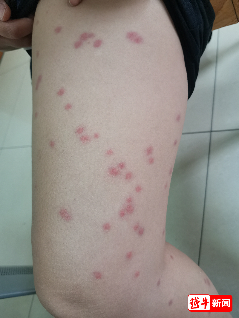 丘疹性荨麻疹发病率增高！家有小孩要注意_腾讯新闻