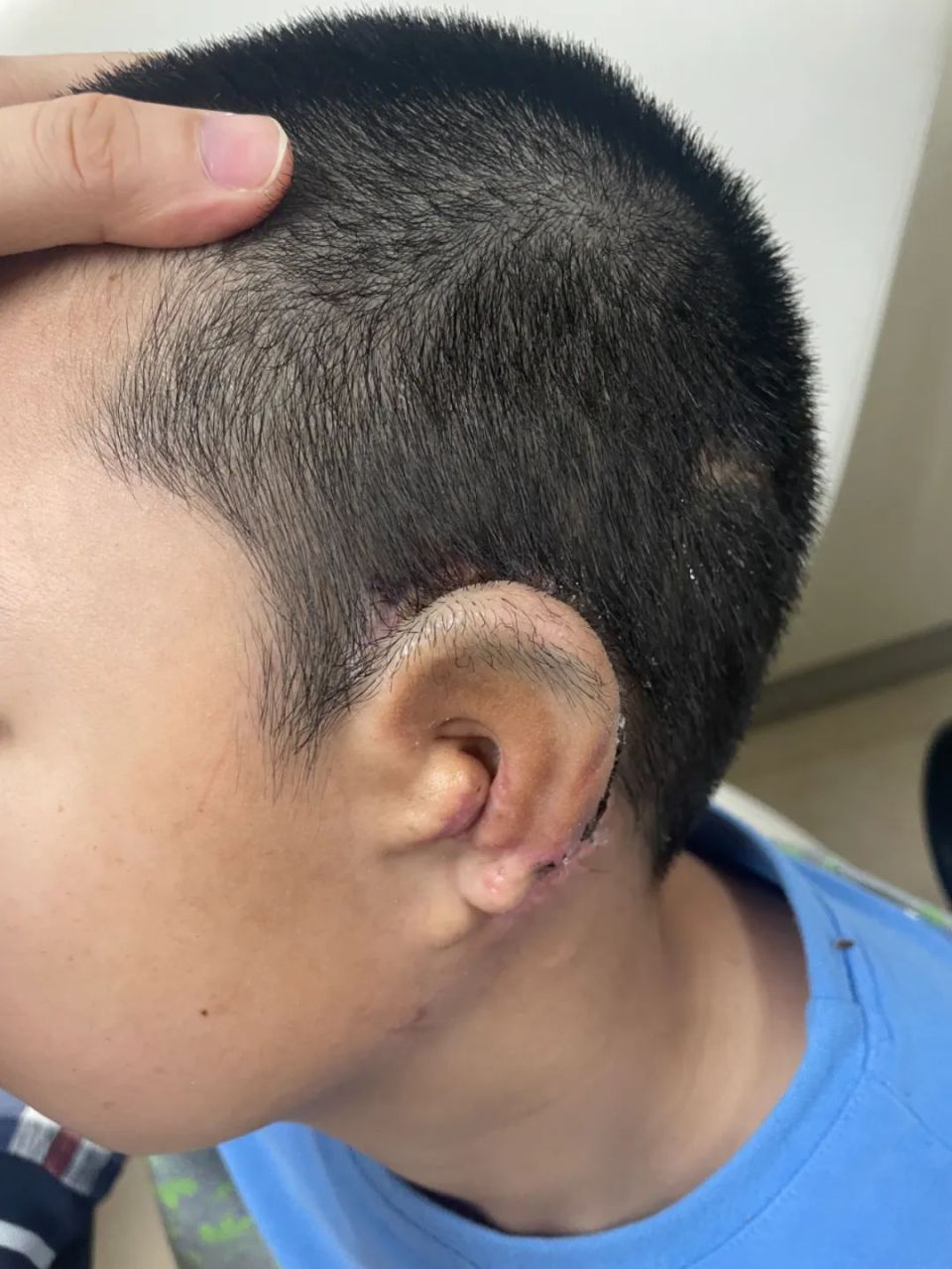 一次手术解决两个问题,逸仙团队成功为7岁小朋友完成耳廓再造Ⅱ期同期