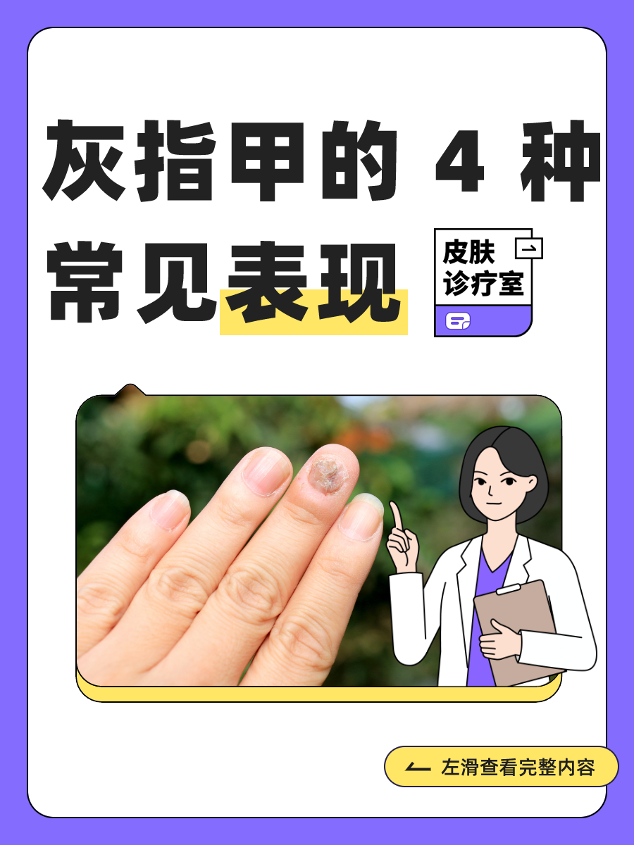 灰指甲不治疗会怎么样?会自己好起来吗?