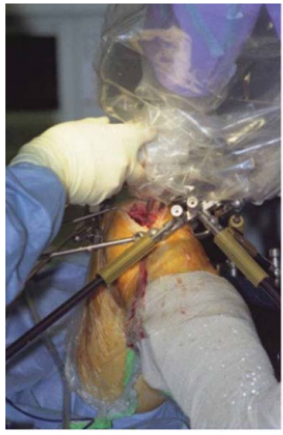 常用x线机器有哪些机器人辅助膝关节单髁置换手术：从过去到未来_https://www.jmylbn.com_新闻资讯_第2张