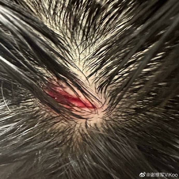 头皮破了仍坚持比赛,谢维军:坚持不懈拿下胜利