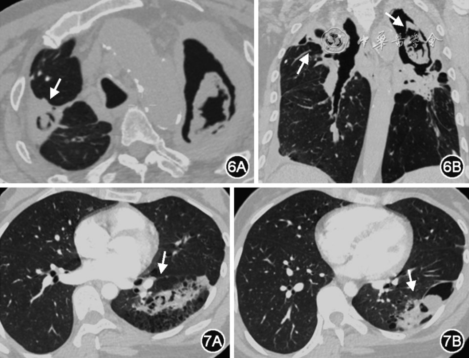 abp在医学是什么意思指南共识︱慢性阻塞性肺疾病伴肺曲霉病诊治和管理专家共识_https://www.jmylbn.com_新闻资讯_第4张