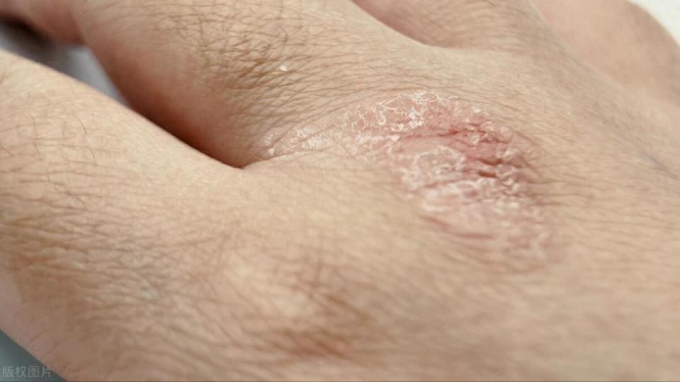 手上长小水泡很痒医生告诉你这不是湿疹答案你可能想不到