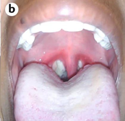 病原体会分泌白喉毒素,严重时毒素会在患者咽喉处引起上皮细胞坏死及