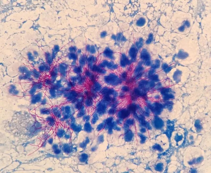 千丝万缕"诺卡君",咳咳痰痰"诺卡菌"